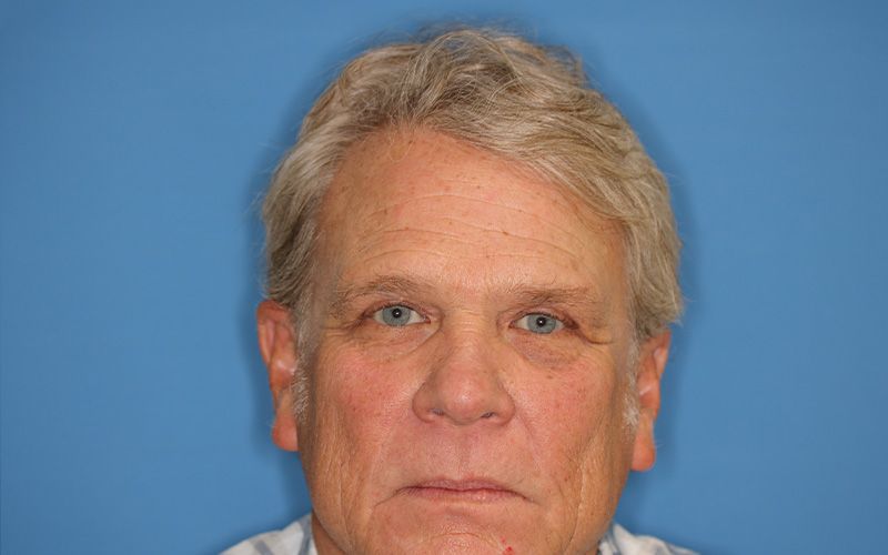 58 year old man who underwent bilateral upper blepharoplasty in office under local anesthesia