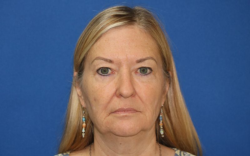 65 year old female underwent deep plane face and neck lift