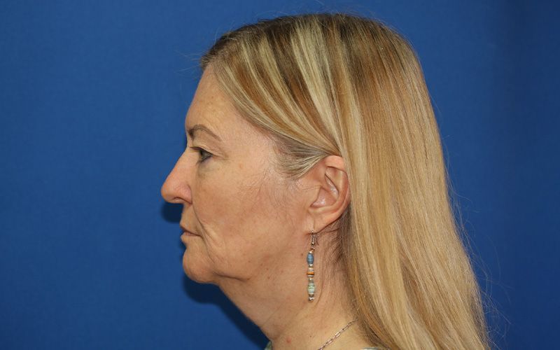 65 year old female underwent deep plane face and neck lift