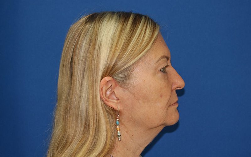 65 year old female underwent deep plane face and neck lift