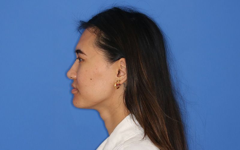 An after picture of a woman who underwent Liquid Rhinoplasty at Carson Williams MD Facial Plastic Surgery in leawood, KS
