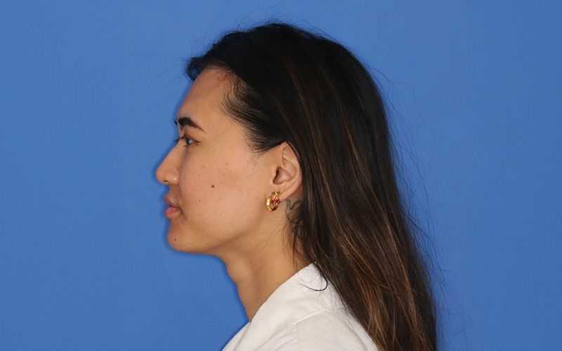 A before picture of a woman who underwent Liquid Rhinoplasty at Carson Williams MD Facial Plastic Surgery in leawood, KS