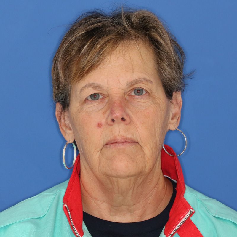 Close up of a woman before eyelid surgery at Carson Williams Facial Plastic Surgery in Leawood, KS