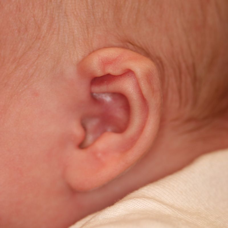 Close up of an infant's ear before EarWell Infant Ear Molding at Carson Williams Facial Plastic Surgery in Leawood, KS