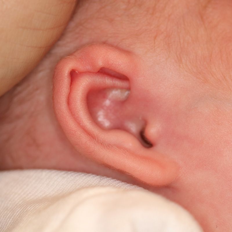 Close up of an infant's ear before EarWell Infant Ear Molding at Carson Williams Facial Plastic Surgery in Leawood, KS