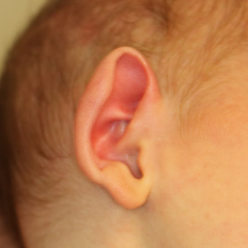 Close up of an infant's ear before EarWell Infant Ear Molding at Carson Williams Facial Plastic Surgery in Leawood, KS