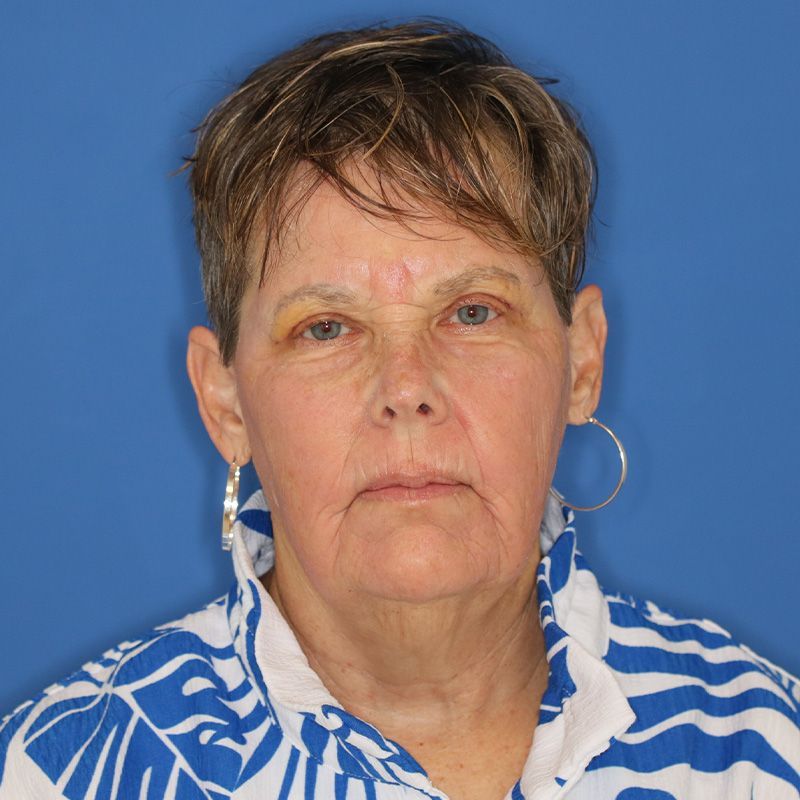 Close up of a woman after eyelid surgery at Carson Williams Facial Plastic Surgery in Leawood, KS