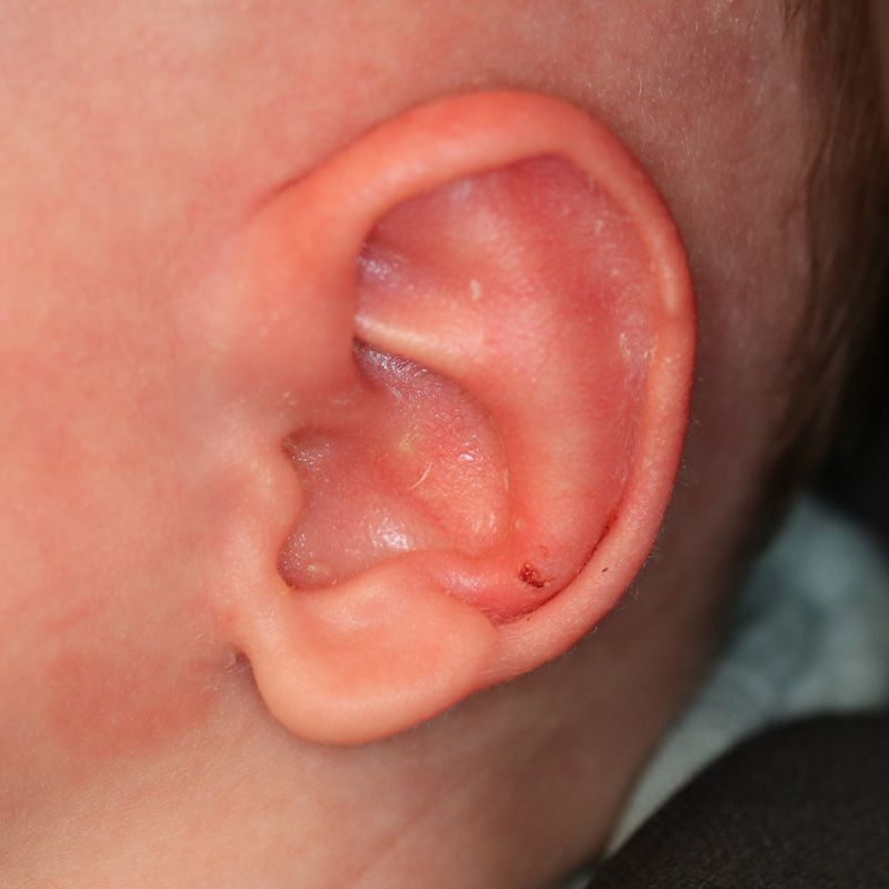 Close up of an infant's ear after EarWell Infant Ear Molding at Carson Williams Facial Plastic Surgery in Leawood, KS