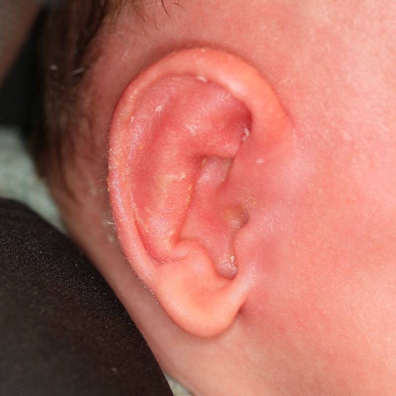 Close up of an infant's ear after EarWell Infant Ear Molding at Carson Williams Facial Plastic Surgery in Leawood, KS