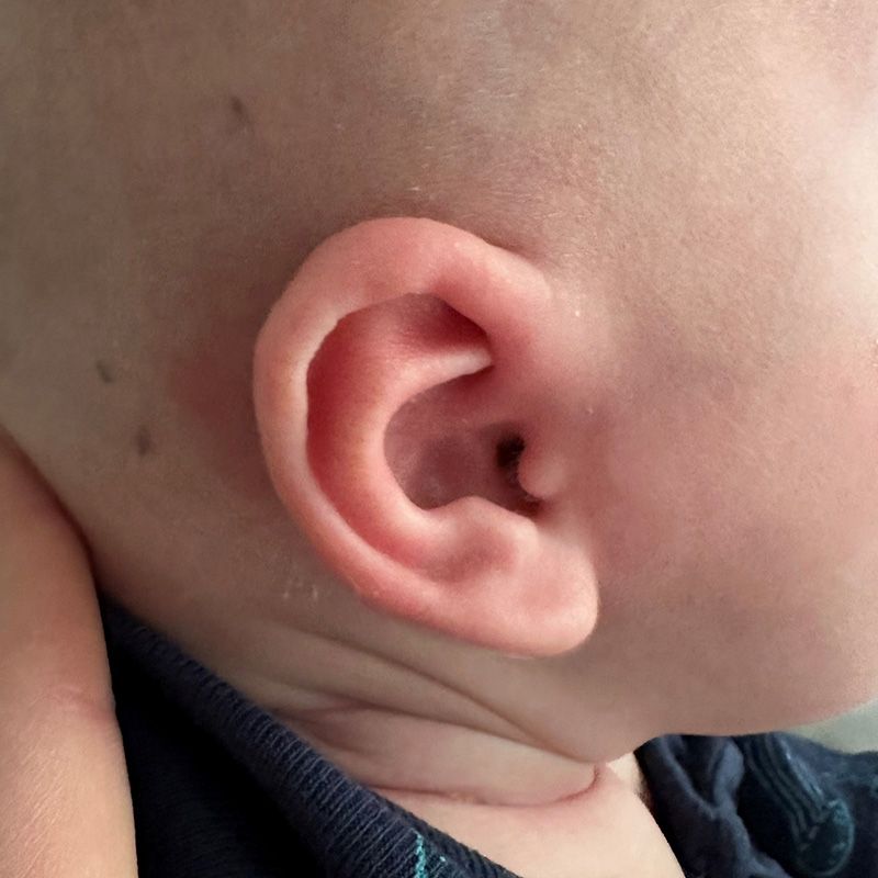 Close up of an infant's ear after EarWell Infant Ear Molding at Carson Williams Facial Plastic Surgery in Leawood, KS