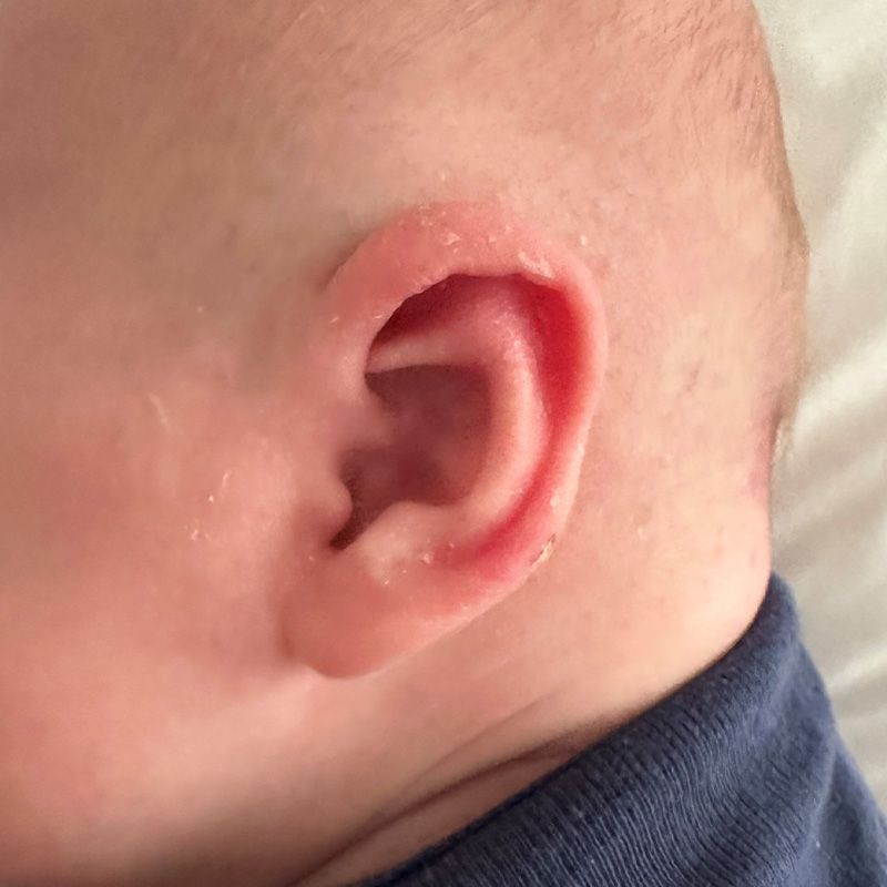 Close up of an infant's ear after EarWell Infant Ear Molding at Carson Williams Facial Plastic Surgery in Leawood, KS