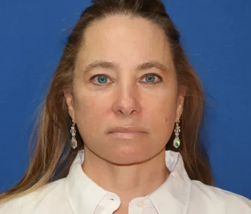 Close up of a woman after Facelift surgery at Carson Williams Facial Plastic Surgery in Leawood, KS