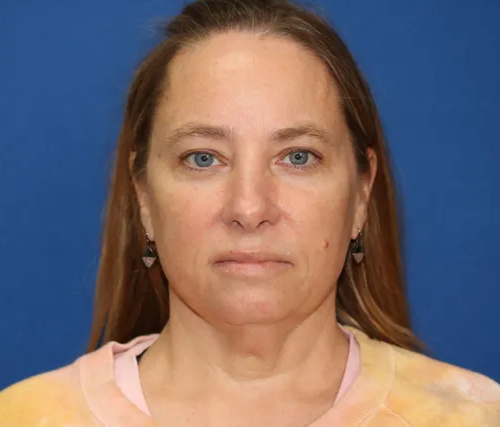 Close up of a woman before Facelift surgery at Carson Williams Facial Plastic Surgery in Leawood, KS