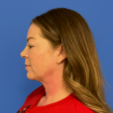 43 year old female before surgery posing in front of a blue background