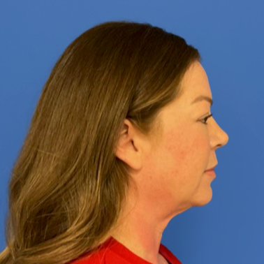 43 year old female facing to the right in front of a blue background