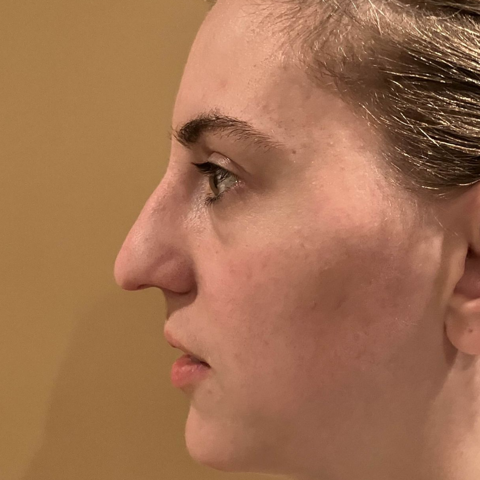 Before Rhinoplasty at Carson Williams, MD Facial Plastic Surgery in Leawood, KS