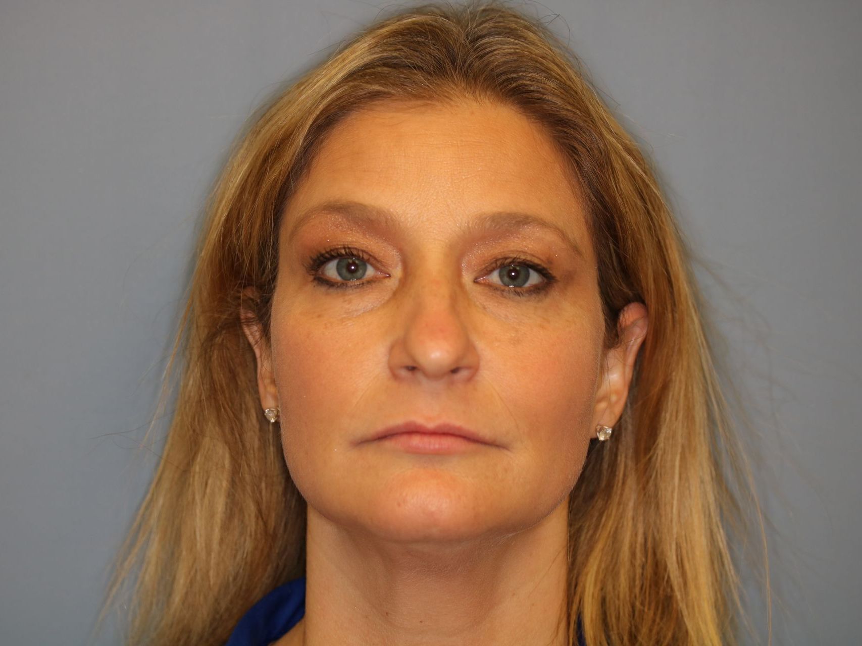 Close up image of a woman's face before rhinoplasty surgery