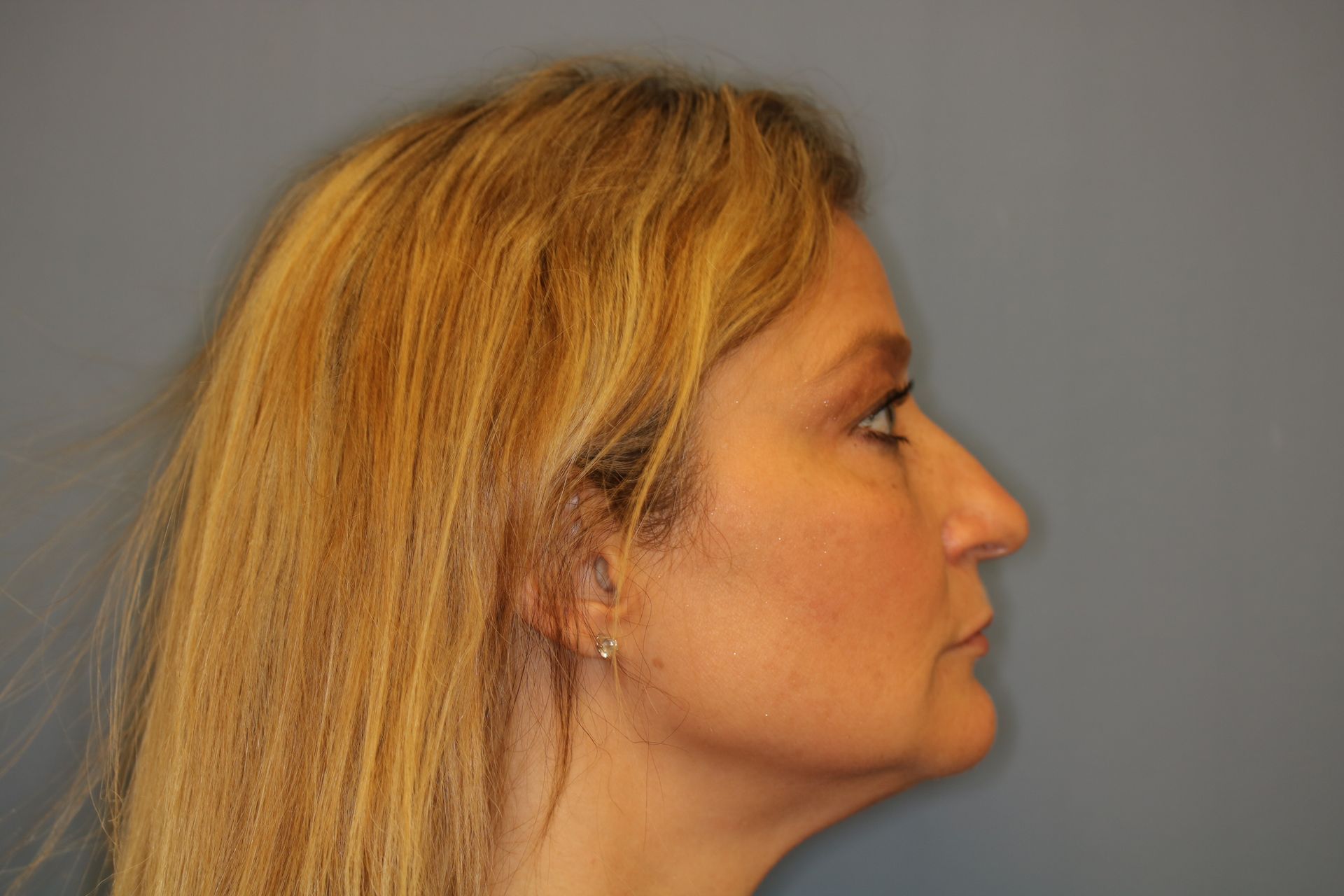 Close up image of a woman's face before rhinoplasty surgery