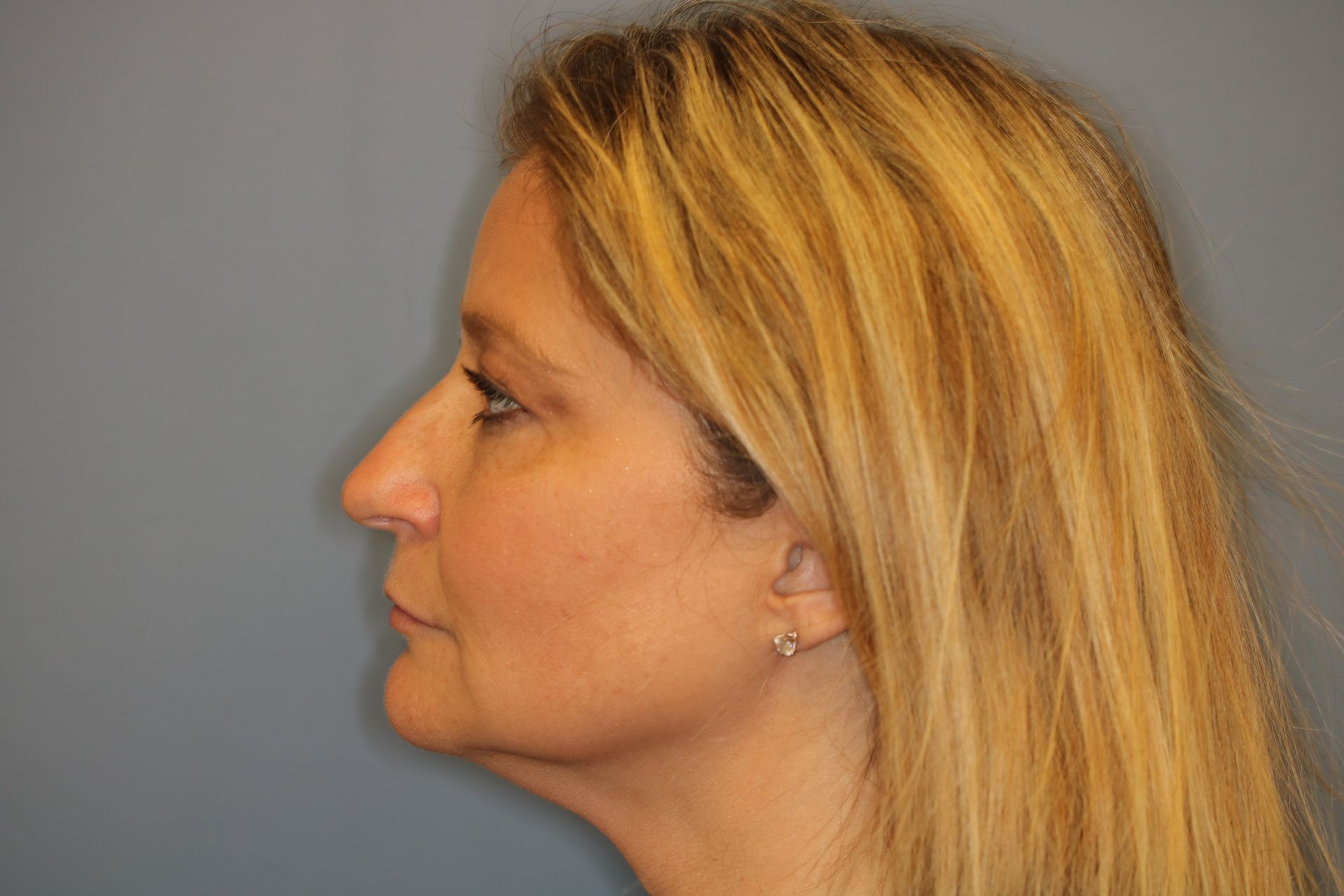 Close up image of a woman's face before rhinoplasty surgery