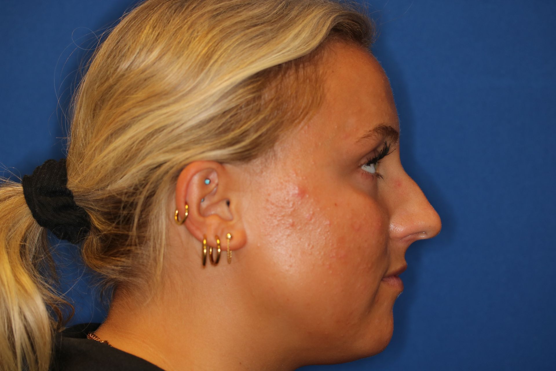 Close up image of a woman's face before rhinoplasty surgery