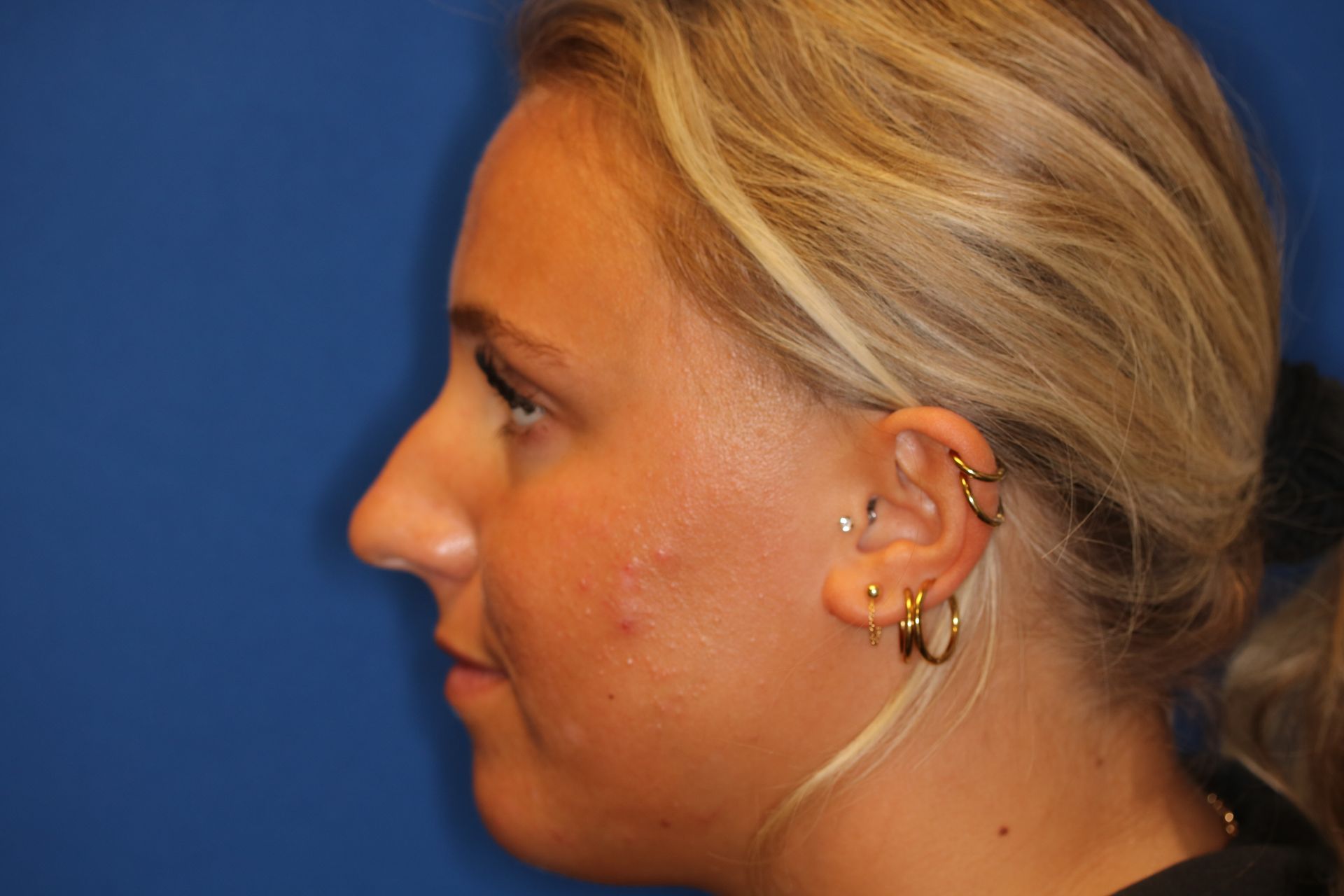 Close up image of a woman's face before rhinoplasty surgery