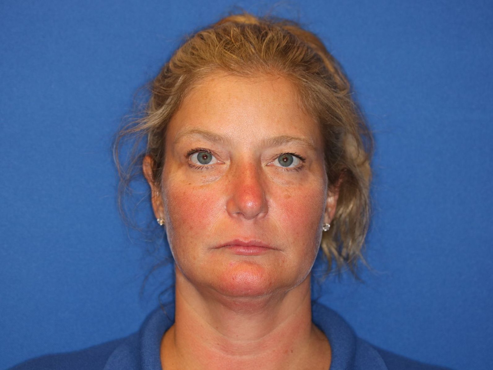 Close up image of a woman's face after rhinoplasty surgery