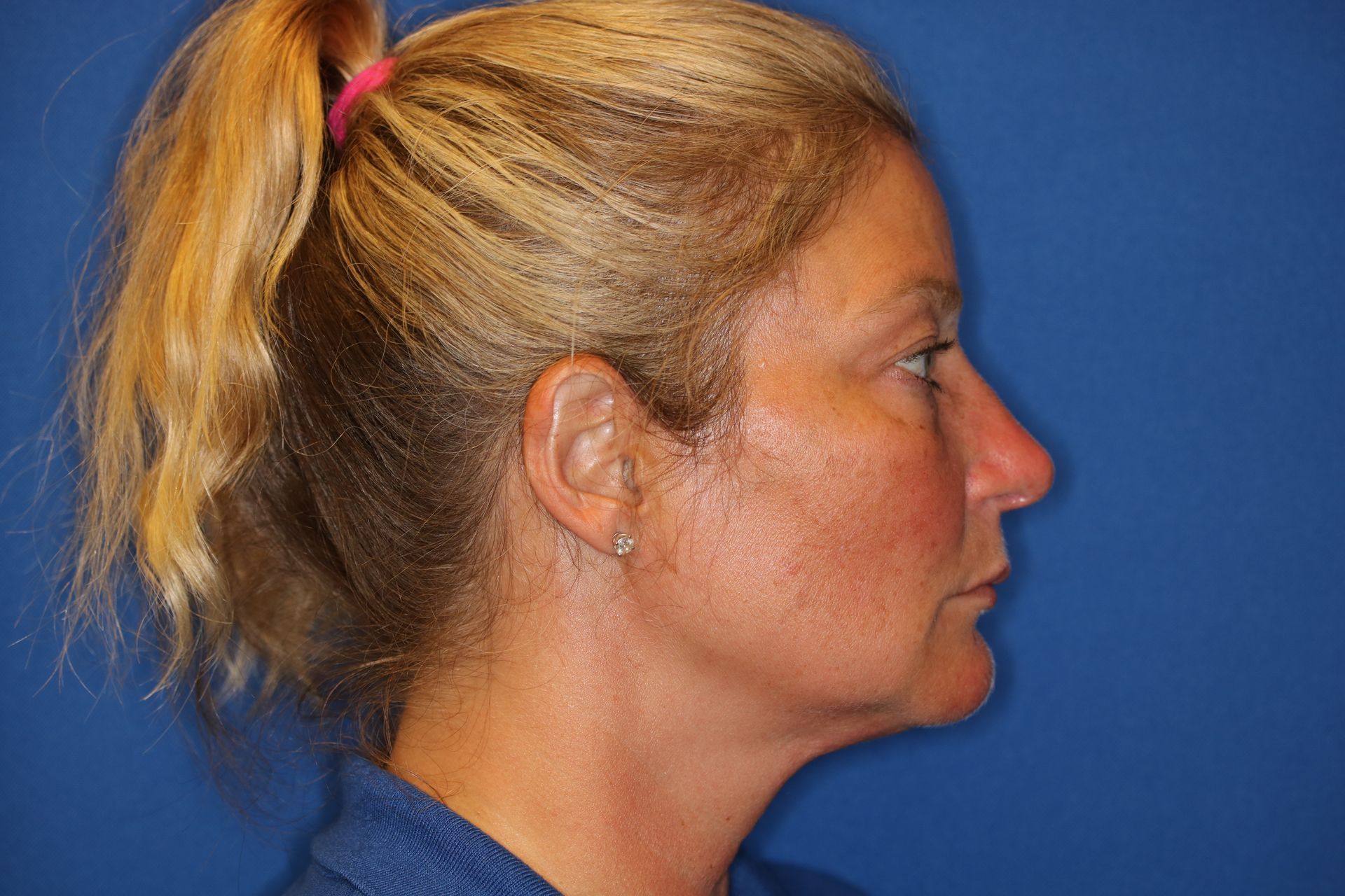 Close up image of a woman's face after rhinoplasty surgery
