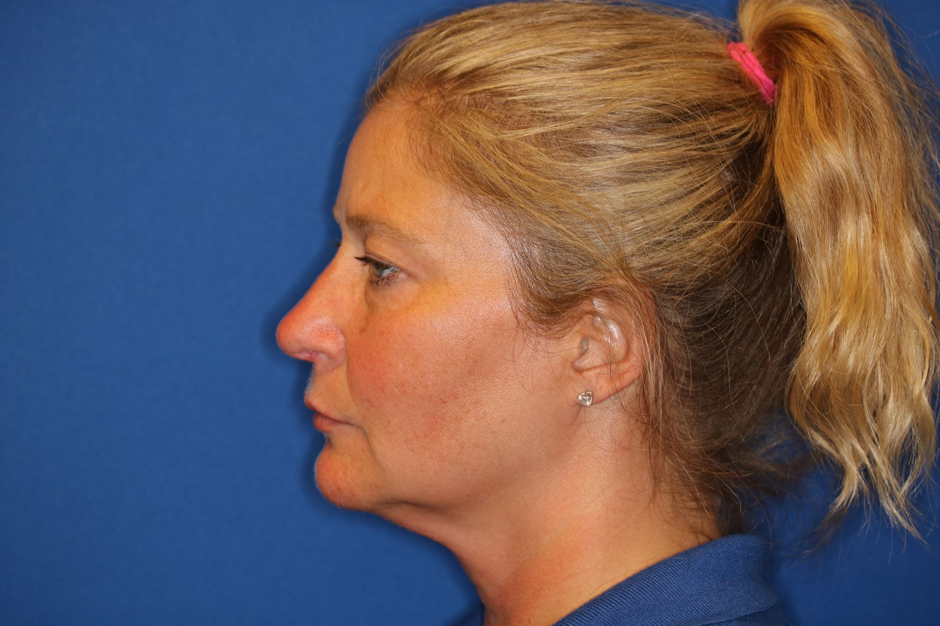 Close up image of a woman's face after rhinoplasty surgery