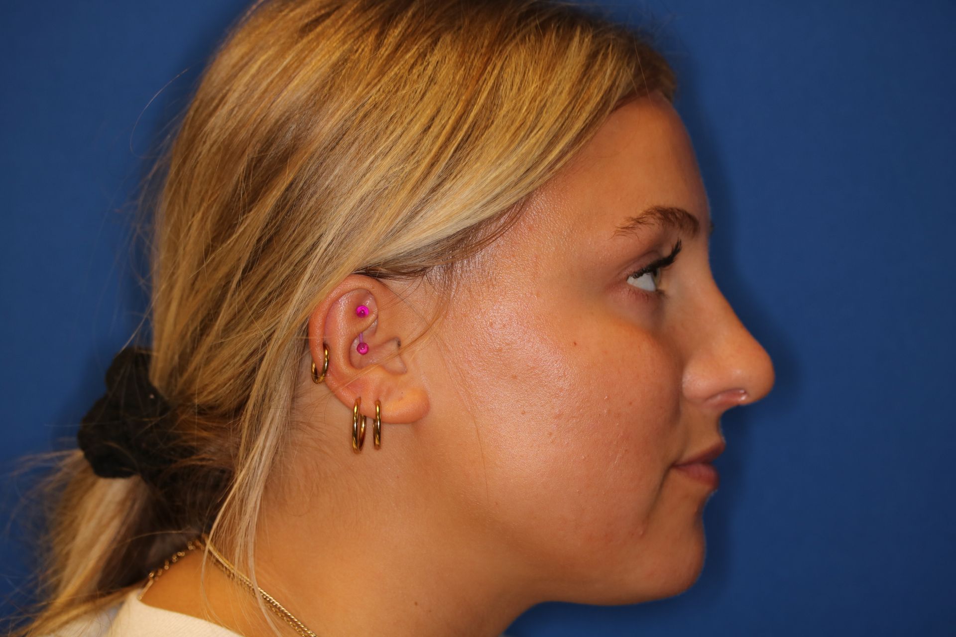 Close up image of a woman's face after rhinoplasty surgery