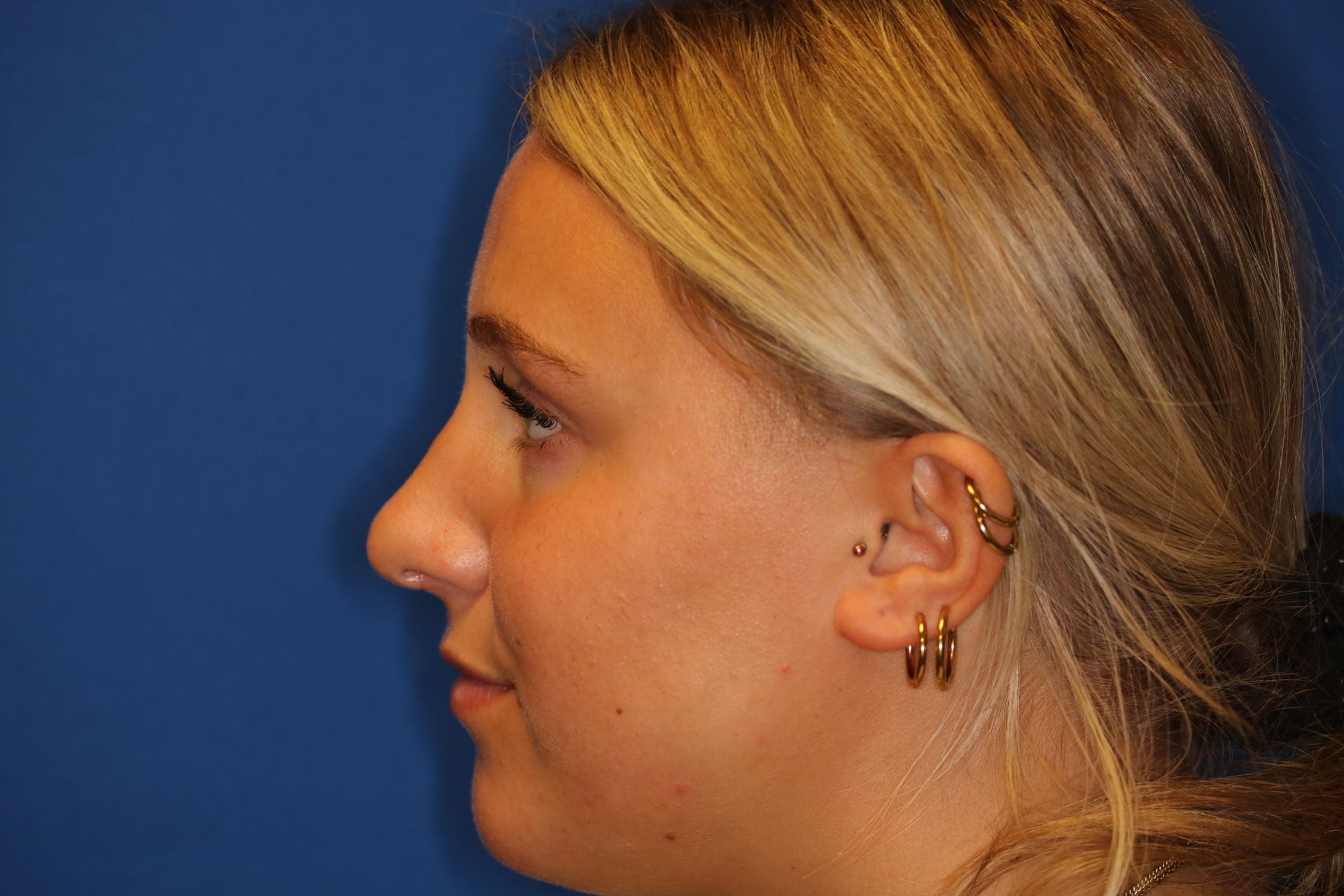 Close up image of a woman's face after rhinoplasty surgery