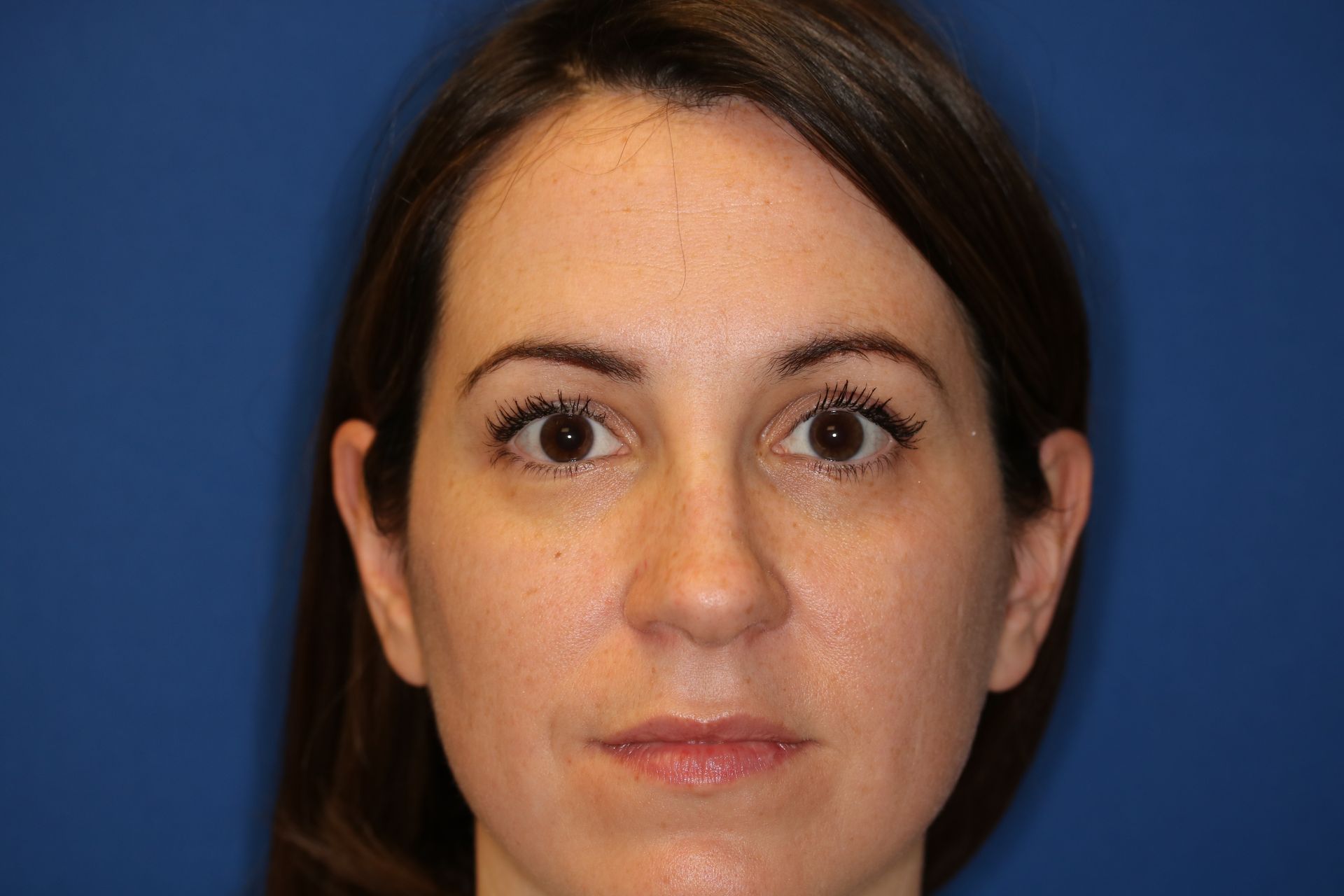 Close up image of a woman's face before rhinoplasty surgery