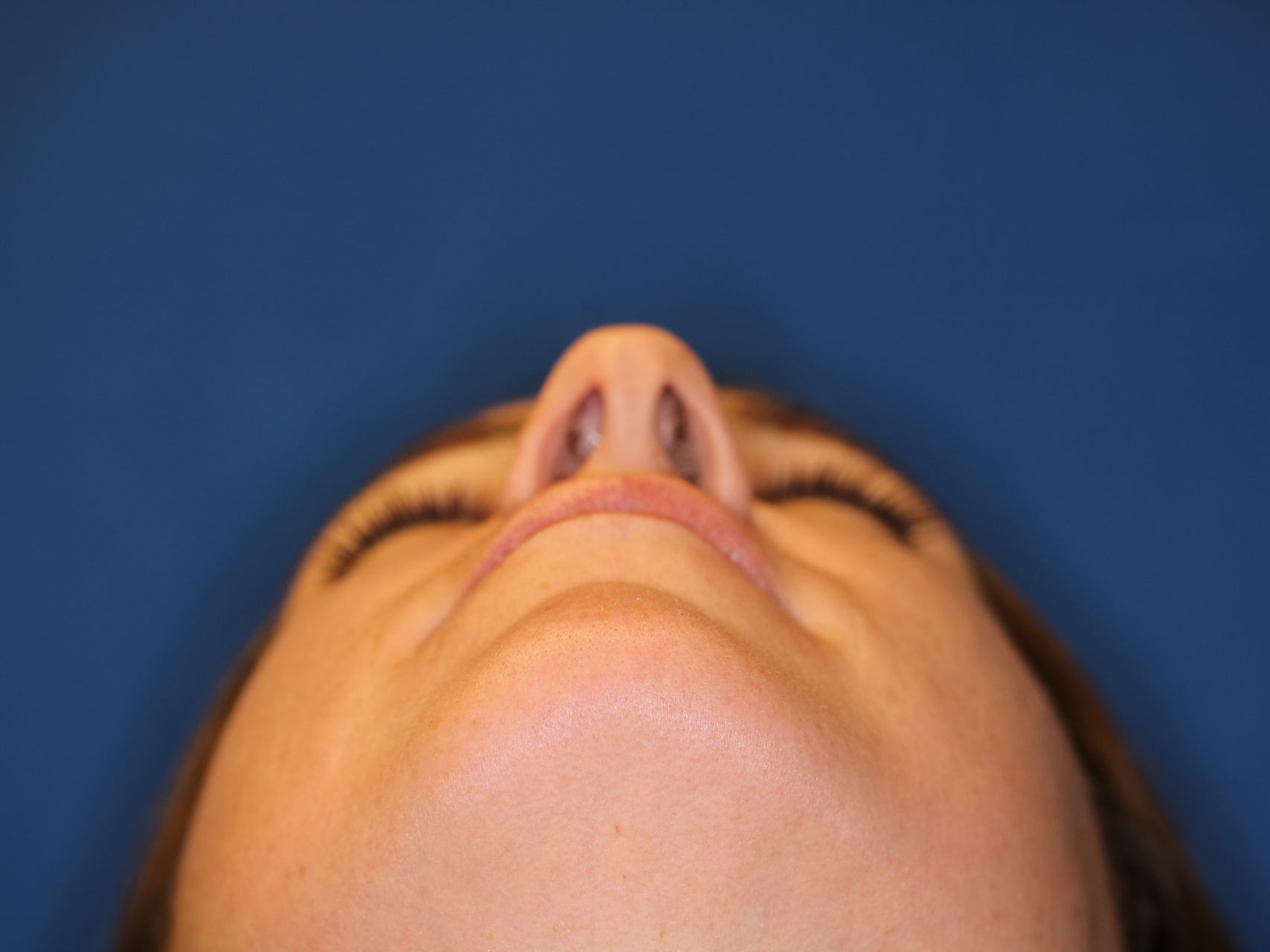Close up image of a woman's face before rhinoplasty surgery at Carson Williams MD Facial Plastic Surgery office in Leawood KS