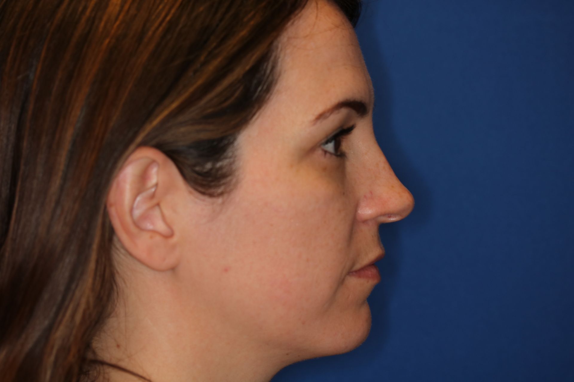 Close up image of a woman's face before rhinoplasty surgery at Carson Williams MD Facial Plastic Surgery office in Leawood KS