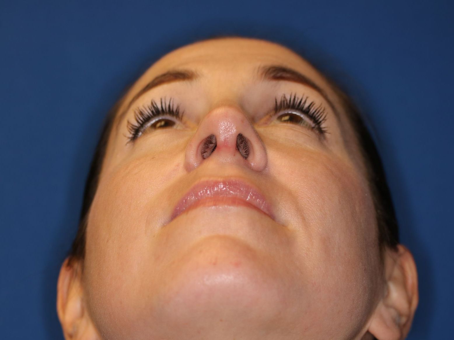 Close up image of a woman's face after rhinoplasty surgery at Carson Williams MD Facial Plastic Surgery office in Leawood KS