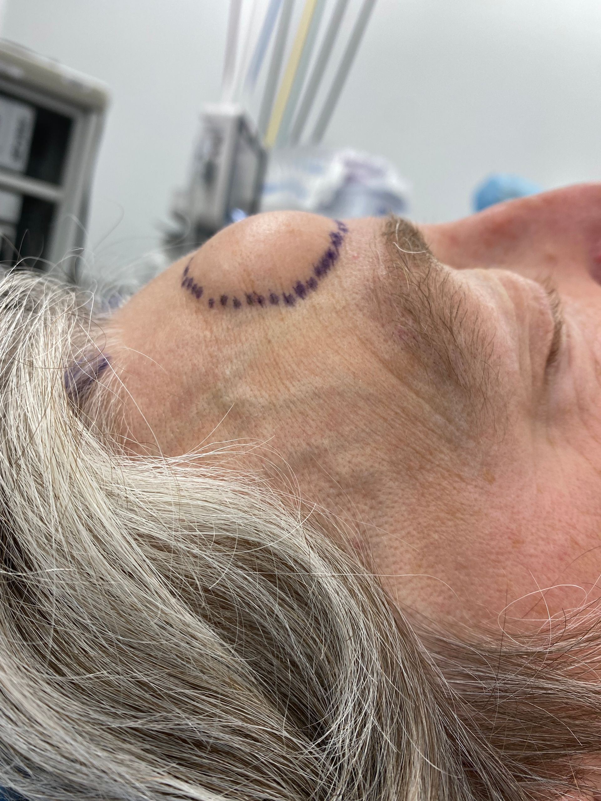 A before picture of a man who underwent cyst removal at Carson Williams MD Facial Plastic Surgery in leawood, KS