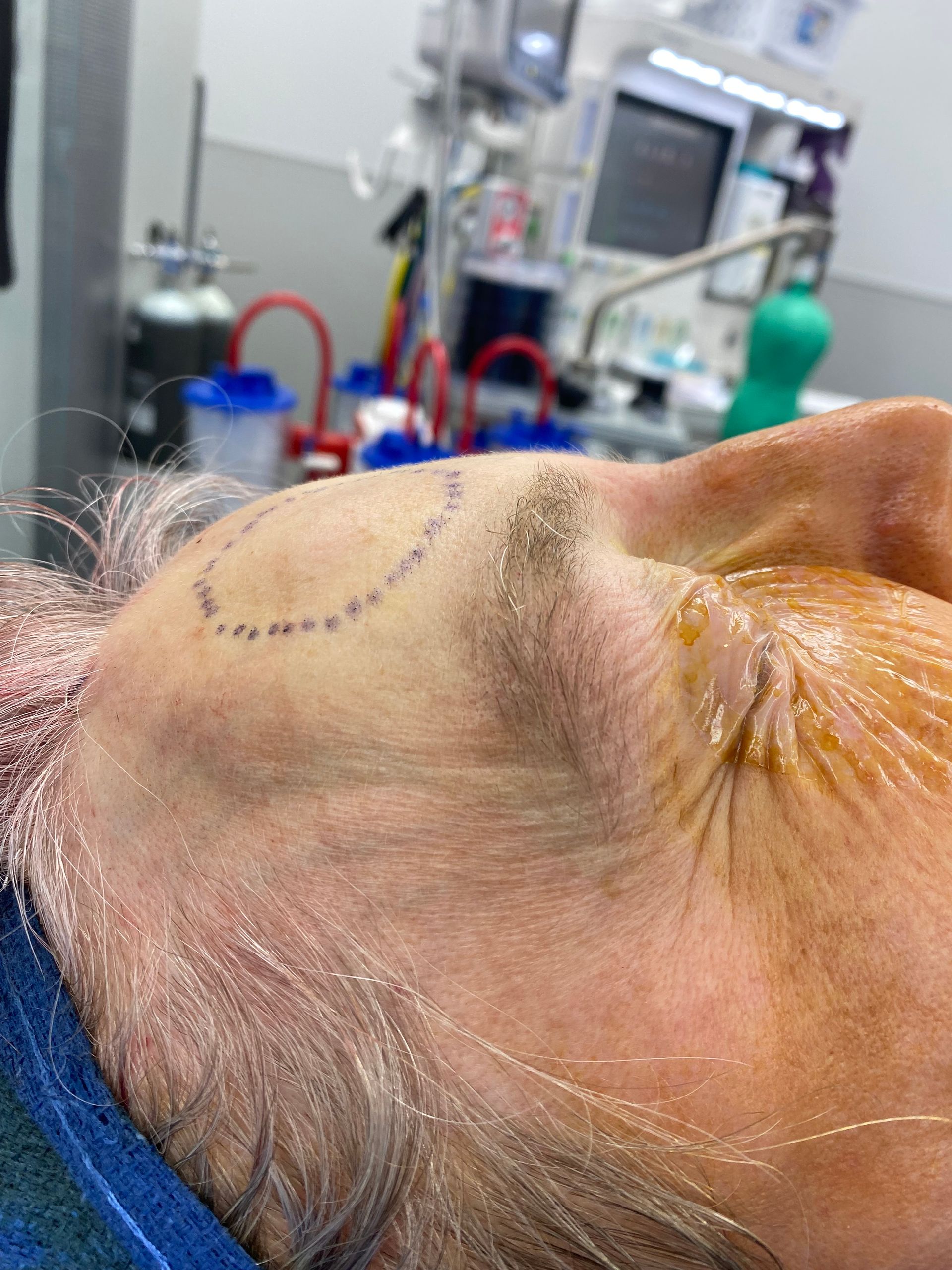 A post-op picture of a man who underwent cyst removal at Carson Williams MD Facial Plastic Surgery in leawood, KS