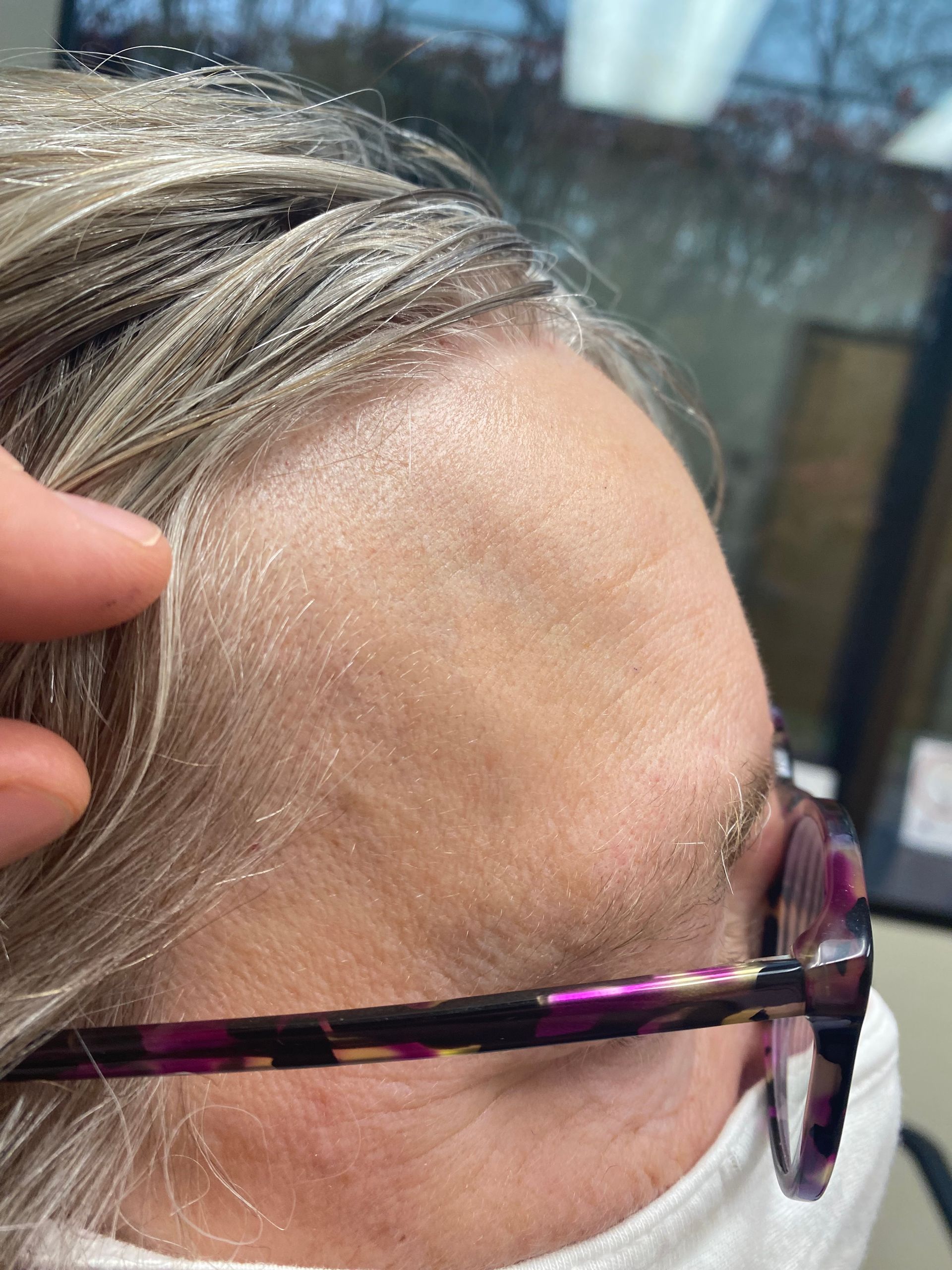 An after picture of a man who underwent cyst removal at Carson Williams MD Facial Plastic Surgery in leawood, KS