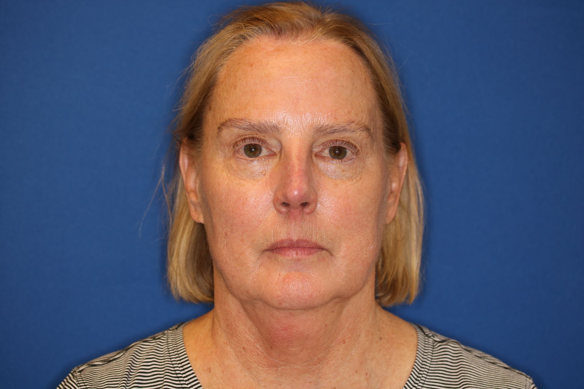 65 year old female underwent deep plane face and neck lift
