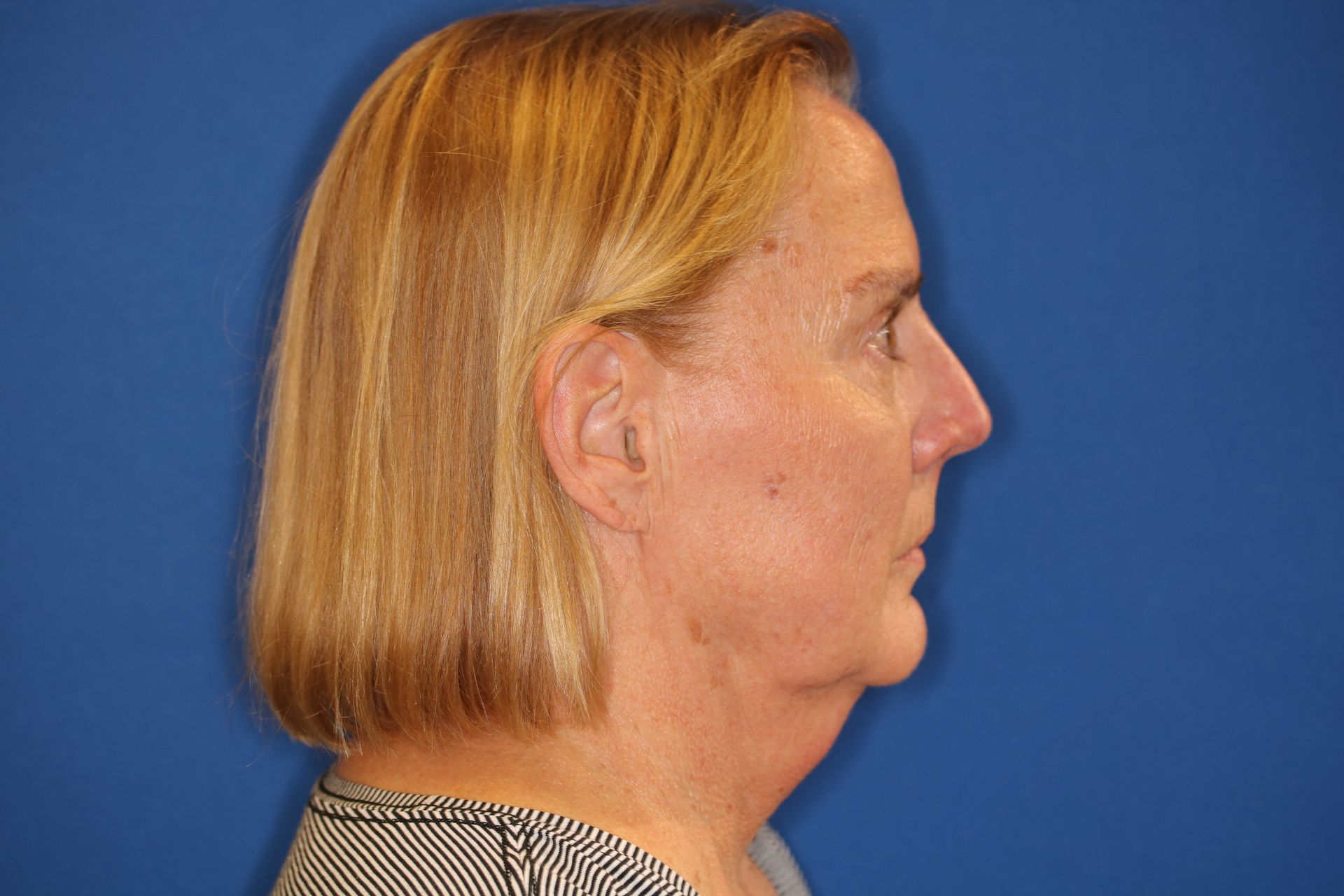 65 year old female underwent deep plane face and neck lift