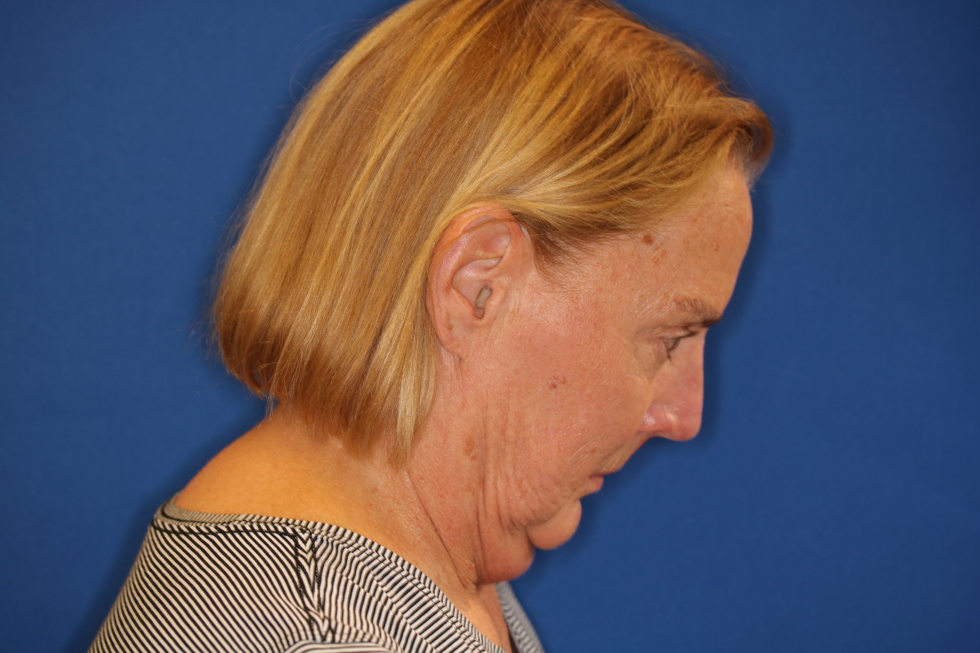 65 year old female underwent deep plane face and neck lift