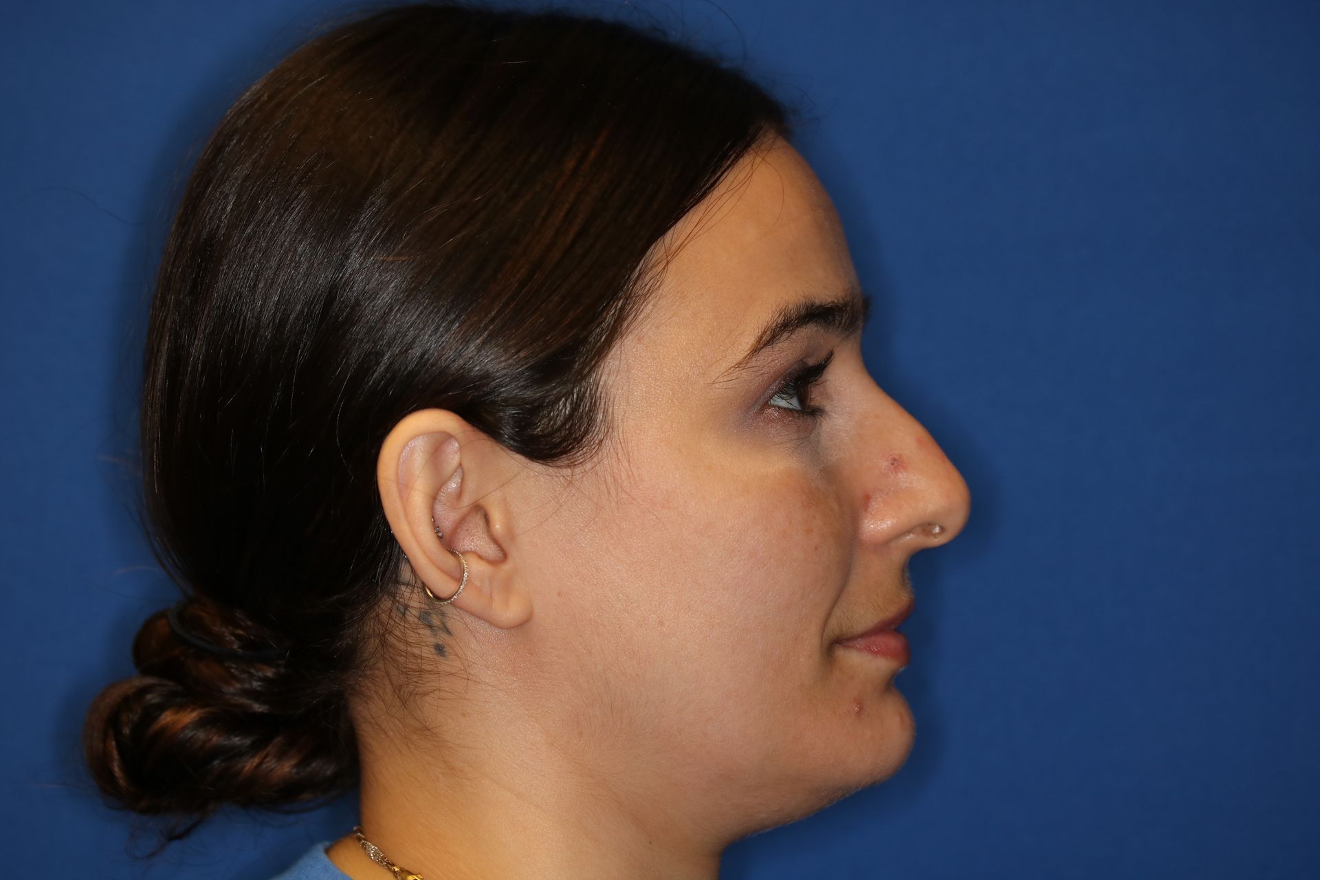 Close up image of a woman's face before rhinoplasty surgery
