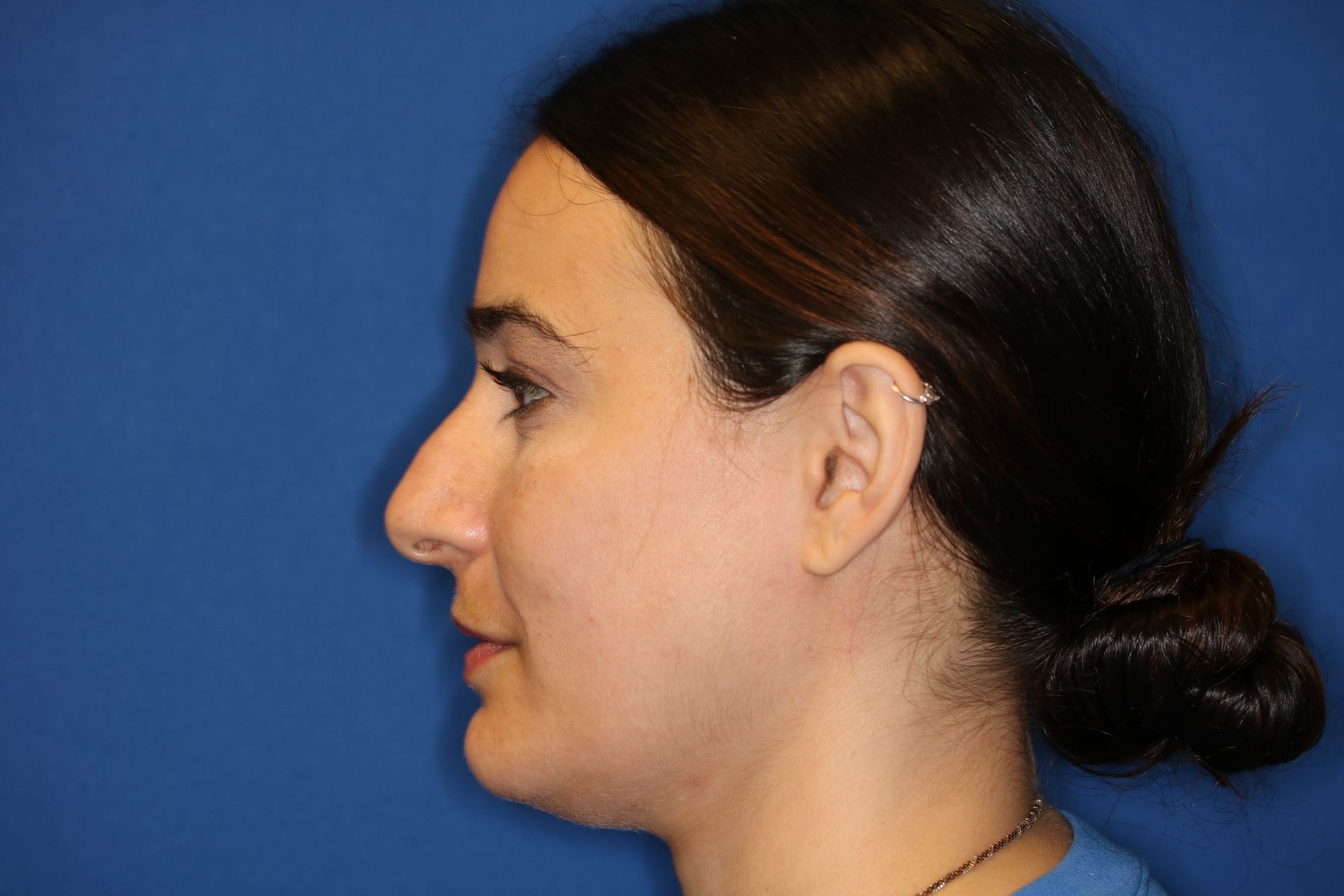 Close up image of a woman's face before rhinoplasty surgery