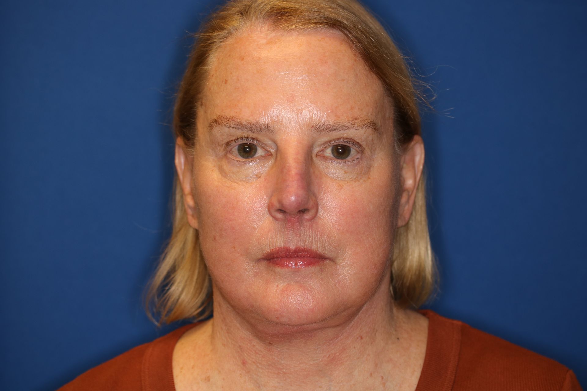 65 year old female underwent deep plane face and neck lift