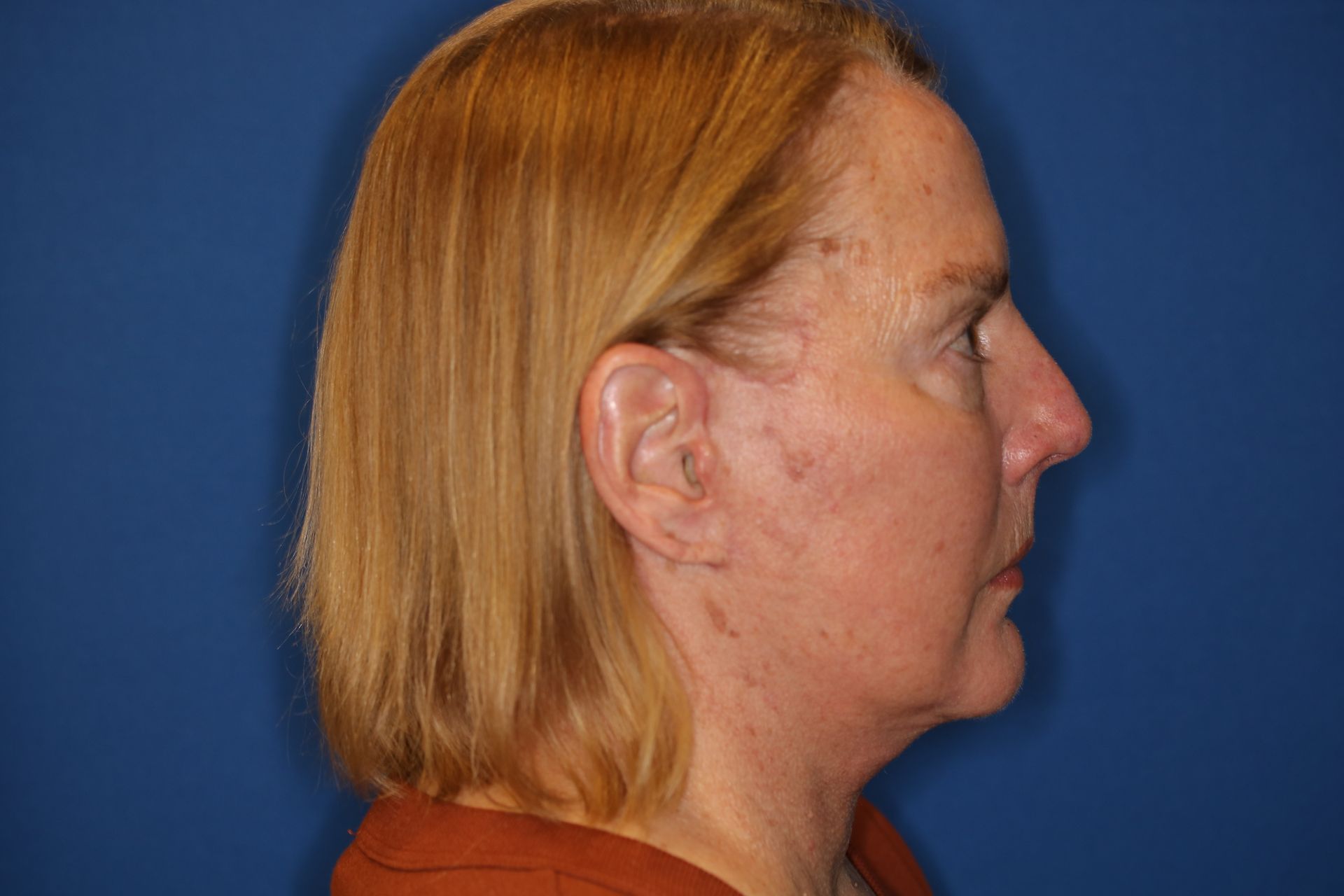 65 year old female underwent deep plane face and neck lift