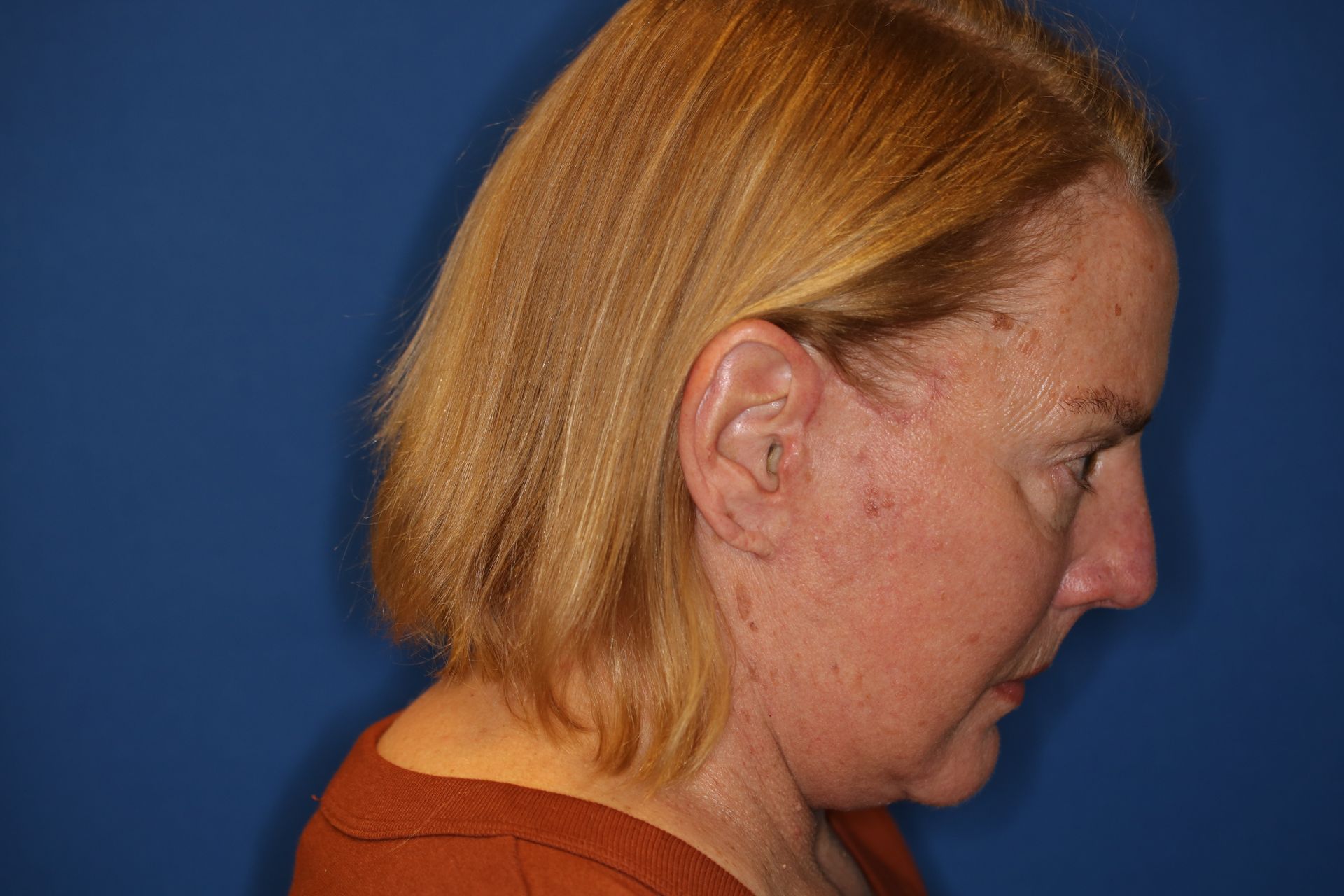 65 year old female underwent deep plane face and neck lift