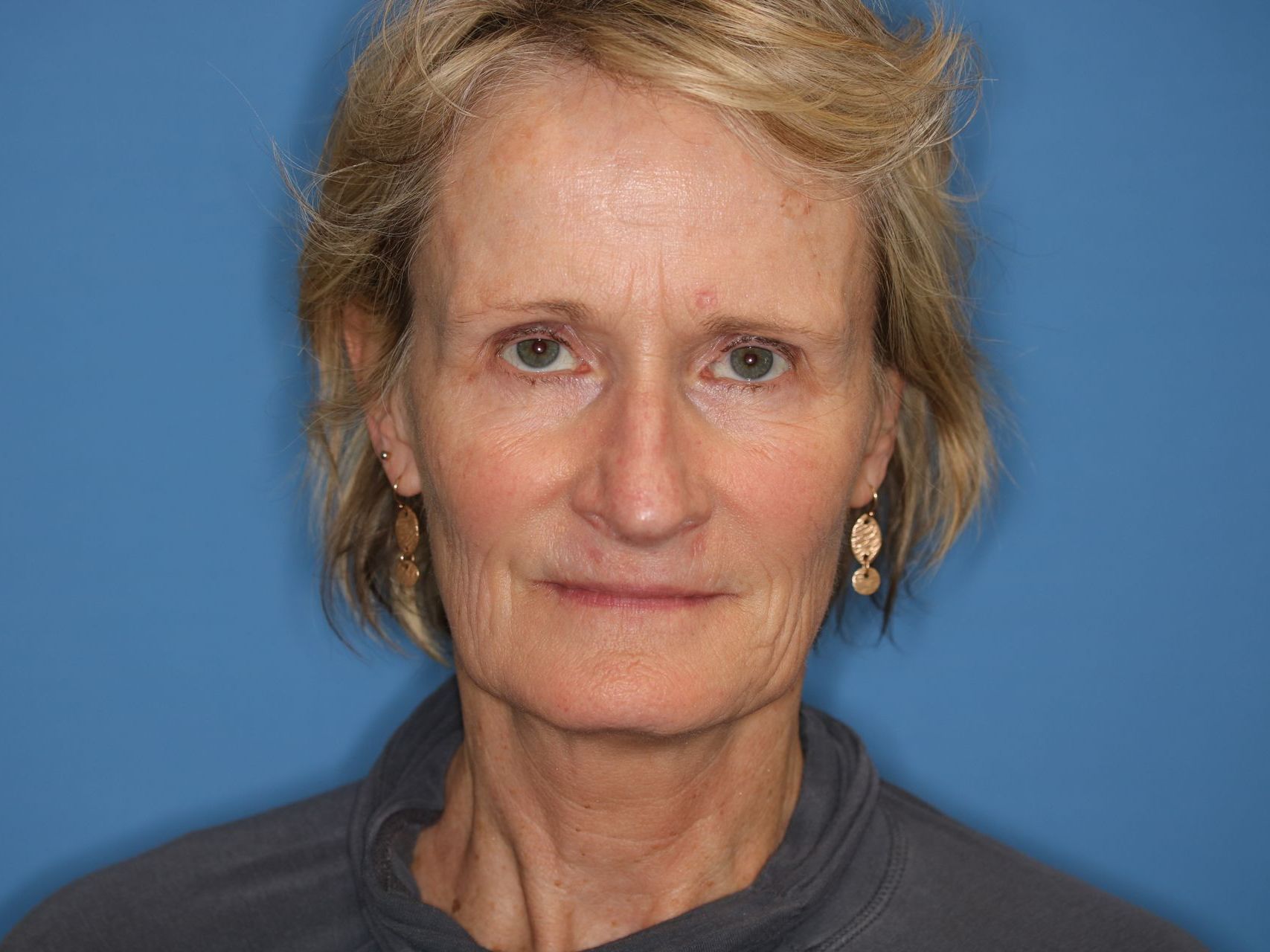 55 year old female who underwent bilateral upper blepharoplasty under local anesthesia in office