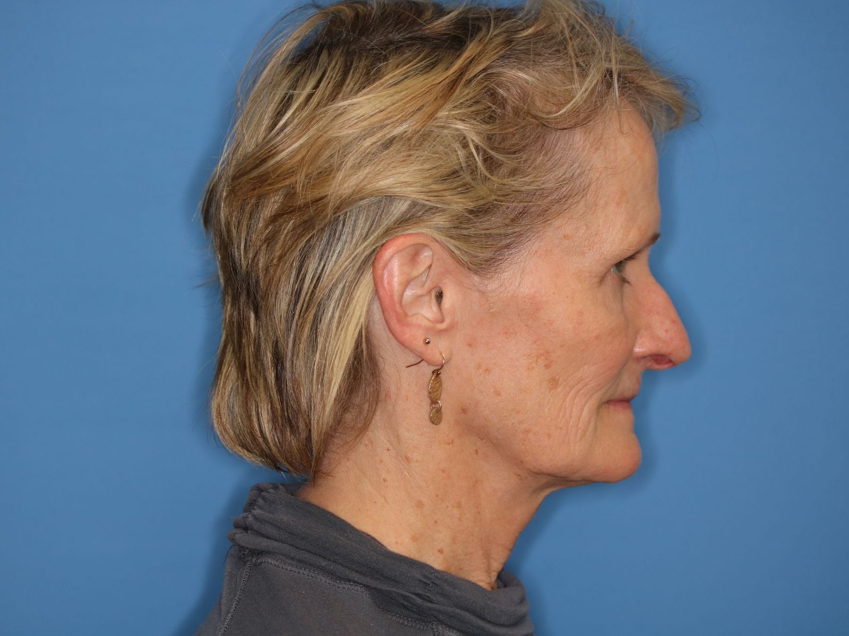 A woman with short blonde hair is standing in front of a blue wall who underwent bilateral upper blepharoplasty