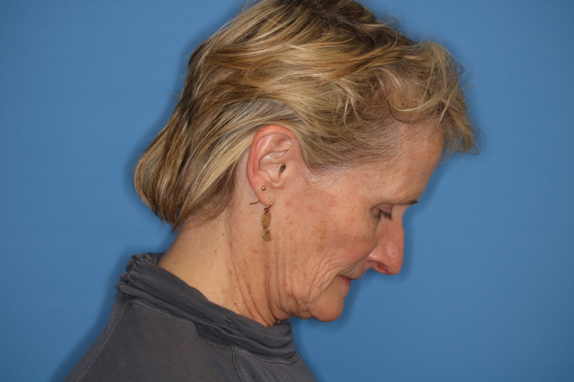 A woman with short blonde hair is standing in front of a blue wall who underwent bilateral upper blepharoplasty