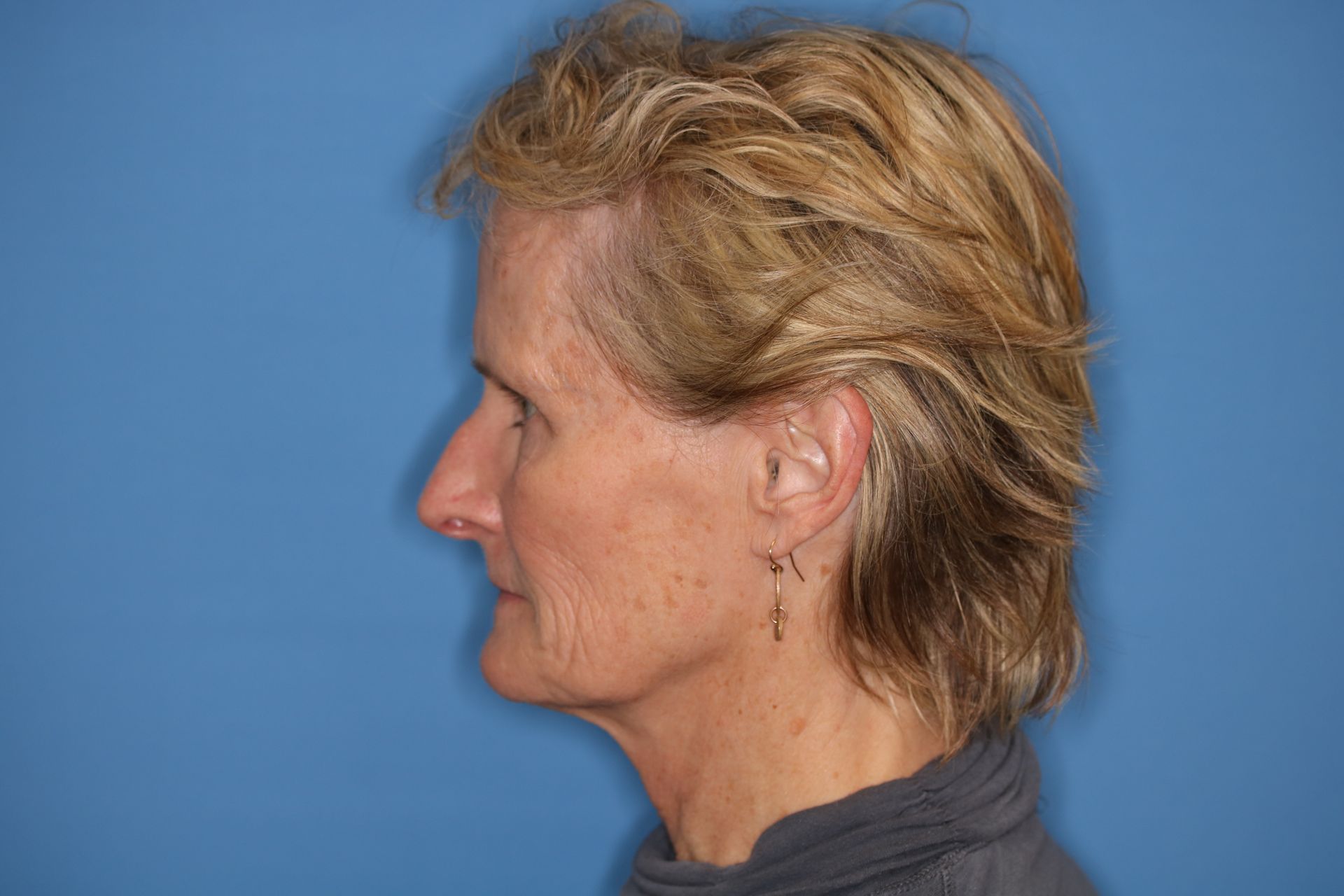 A woman with short blonde hair is standing in front of a blue wall who underwent bilateral upper blepharoplasty