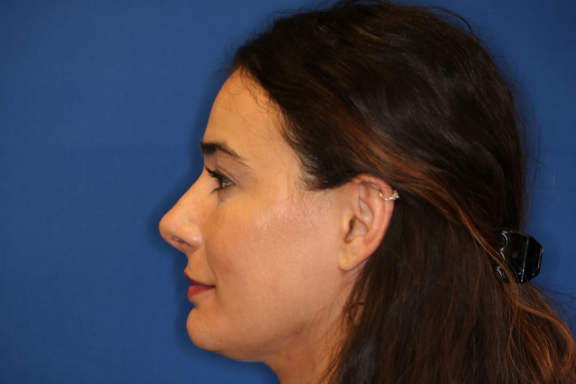 Close up image of a woman's face after rhinoplasty surgery